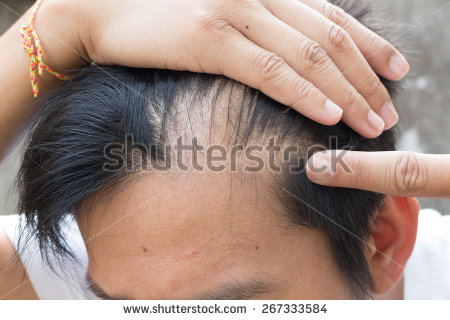 regrow frontal hairline naturally